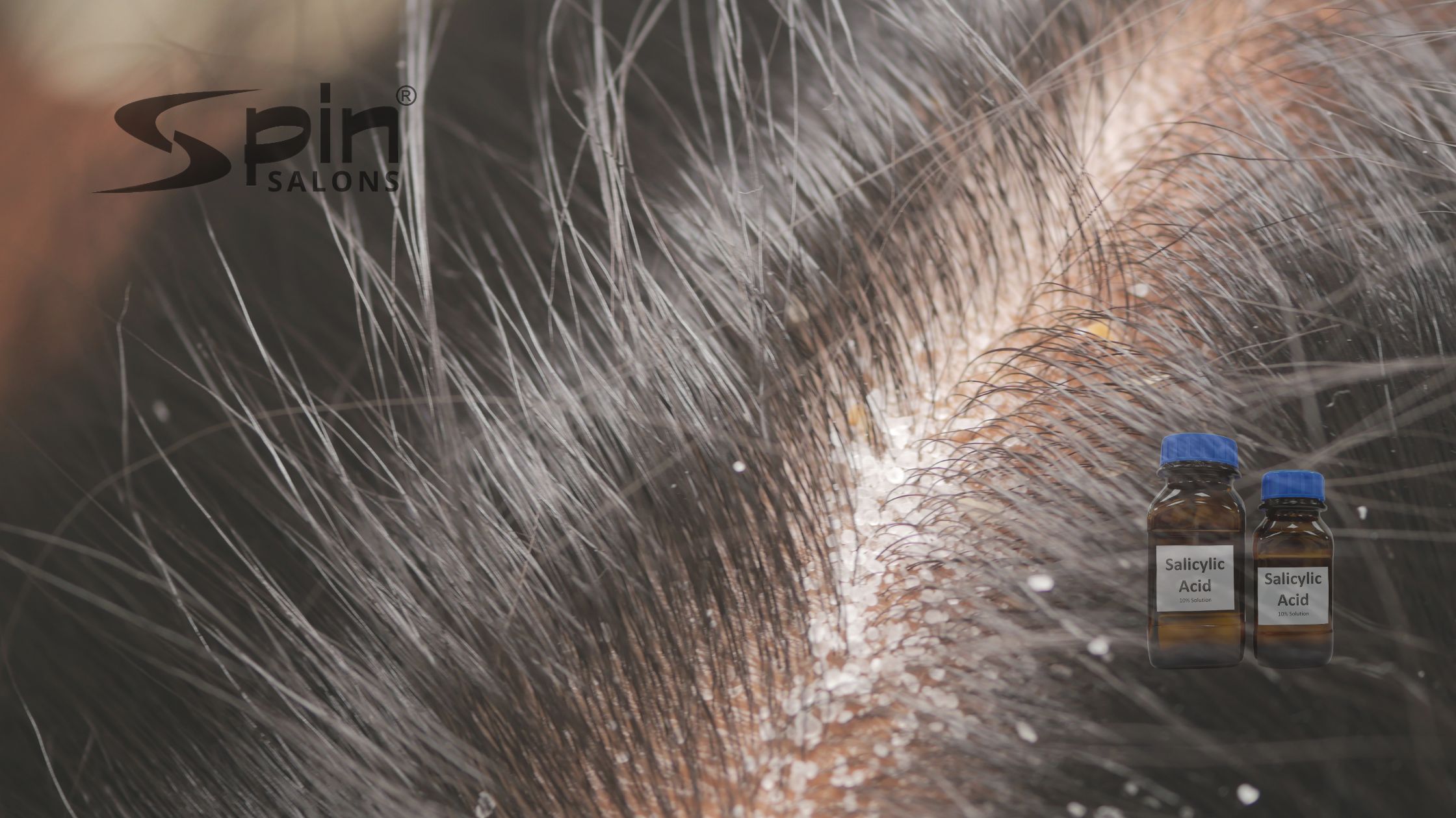 Salicylic Acid for Scalp: The Ultimate Dandruff Solution